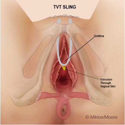 tvt-sling-removal